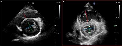 Normal Echocardiographic Reference Values of the Right Ventricular to Left Ventricular Endsystolic Diameter Ratio and the Left Ventricular Endsystolic Eccentricity Index in Healthy Children and in Children With Pulmonary Hypertension